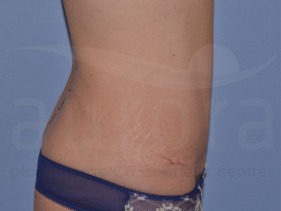 After-Tummy Tuck