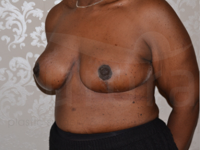 After-Breast uplift
