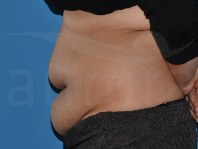 Before-Tummy Tuck