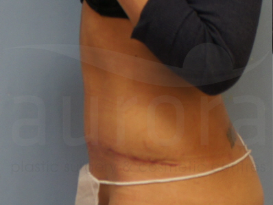 After-Tummy Tuck