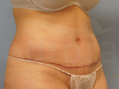 After-Tummy TUck