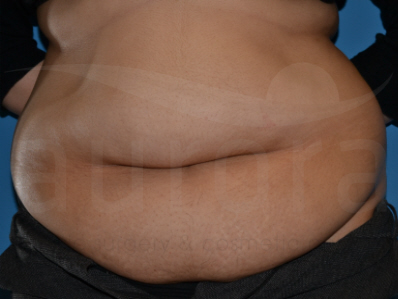 Before-Tummy Tuck