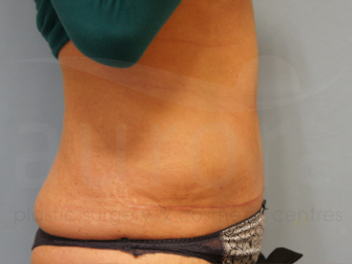 After-Tummy Tuck