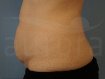 Before-Tummy Tuck