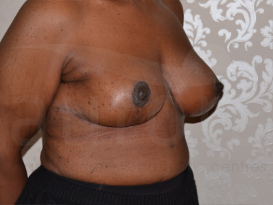 After-Breast uplift