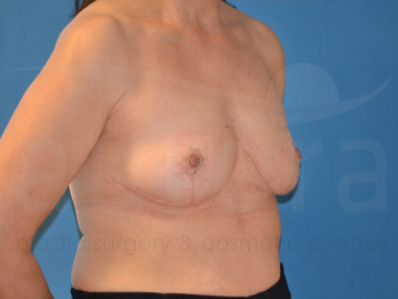 After-Breast Implant Removal