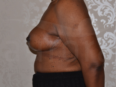 After-Breast uplift