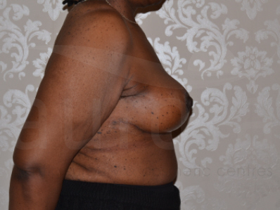 After-Breast uplift