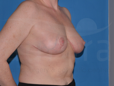 After-Breast Reduction