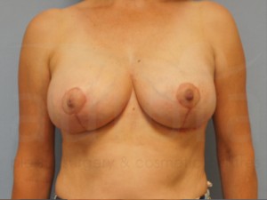 View our latest before and after photos of breast reduction surgery