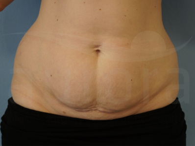 Before-Tummy Tuck