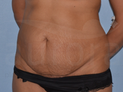 Before-Tummy Tuck