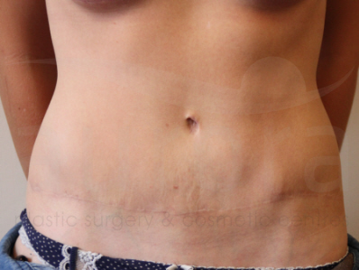 After-Tummy Tuck