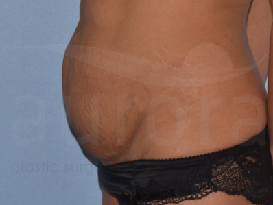 Before-Tummy Tuck