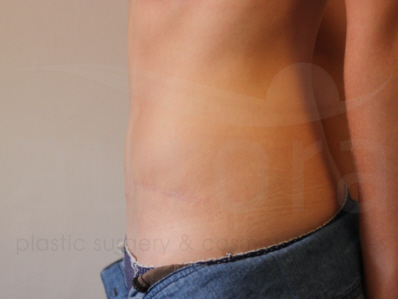 After-Tummy Tuck