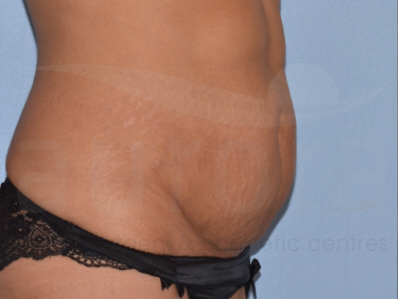 Before-Tummy Tuck