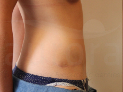 After-Tummy Tuck