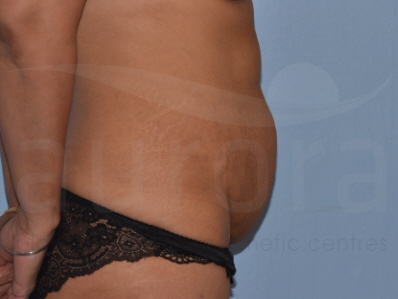 Before-Tummy Tuck