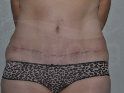 After-Tummy Tuck