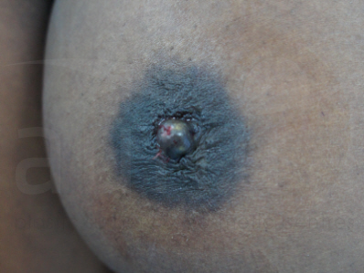 After-Inverted nipple