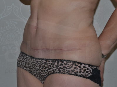 After-Tummy Tuck