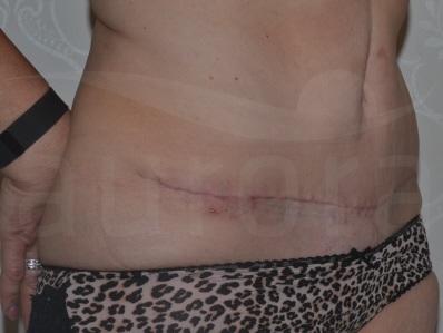 After-Tummy Tuck