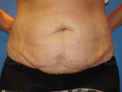 Before-Tummy Tuck