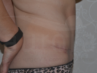 After-Tummy Tuck