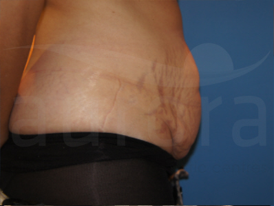 Before-Tummy Tuck