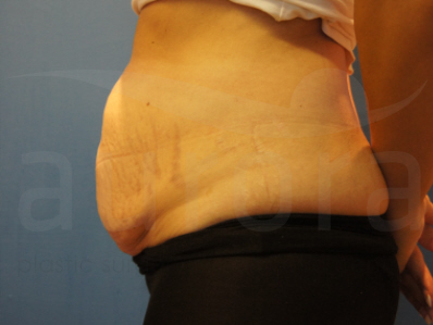 Before-Tummy Tuck