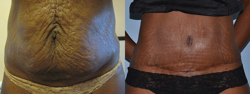 What are the Different Types of Tummy Tuck Scars? - Harley Clinic