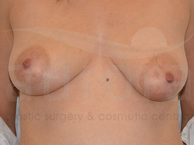 Before-Areola Reduction