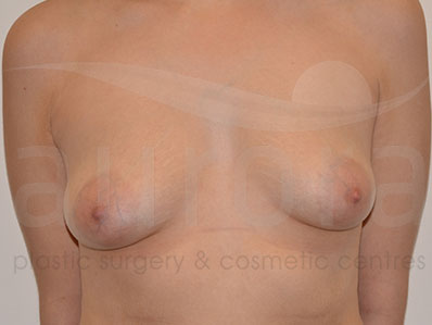 Before-Areola Reduction