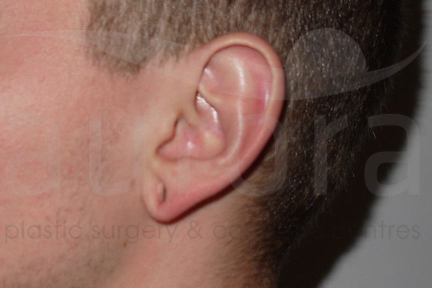 Before-Stretched earlobe repair