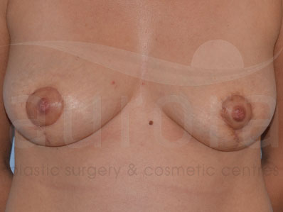 After-Areola Reduction