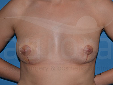After-Areola Reduction