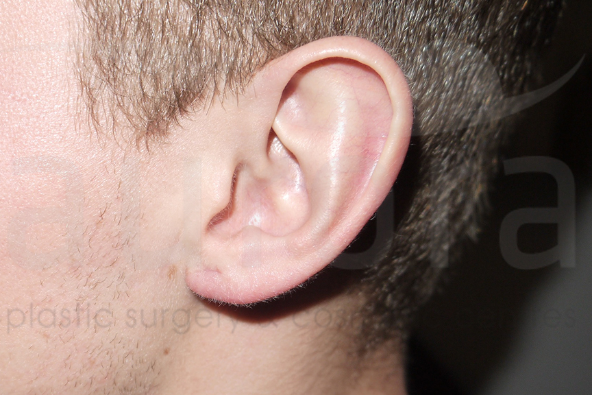 After-Stretched earlobe repair