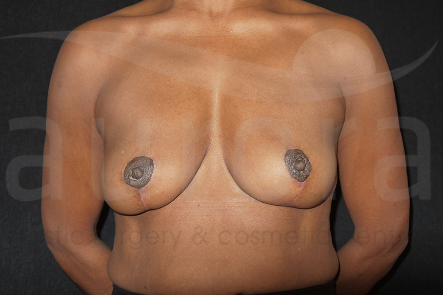 After-Implant Removal with Uplift