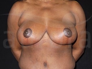 After Photo: Breast Reduction 23402