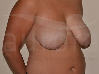 Before-Breast Uplift