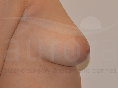 Before-Areola Reduction