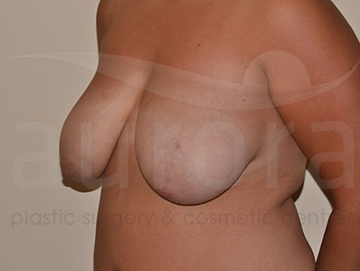 Before-Breast Uplift