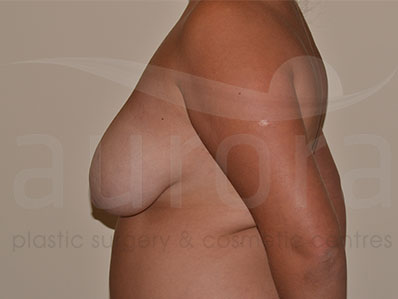 Before-Breast Uplift