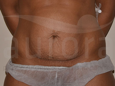 Before-Abdominoplasty Surgery