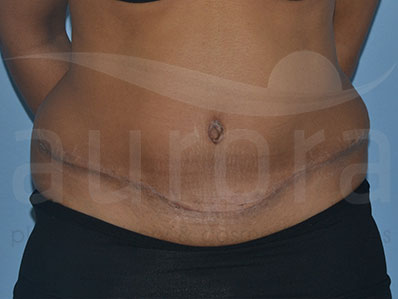 After-Abdominoplasty Surgery