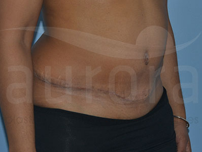 After-Abdominoplasty Surgery