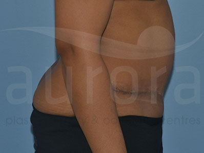 After-Abdominoplasty Surgery