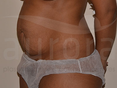 Before-Abdominoplasty Surgery