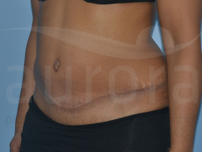 After-Abdominoplasty Surgery