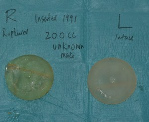 Aurora Clinics; impage showing a ruptured implant